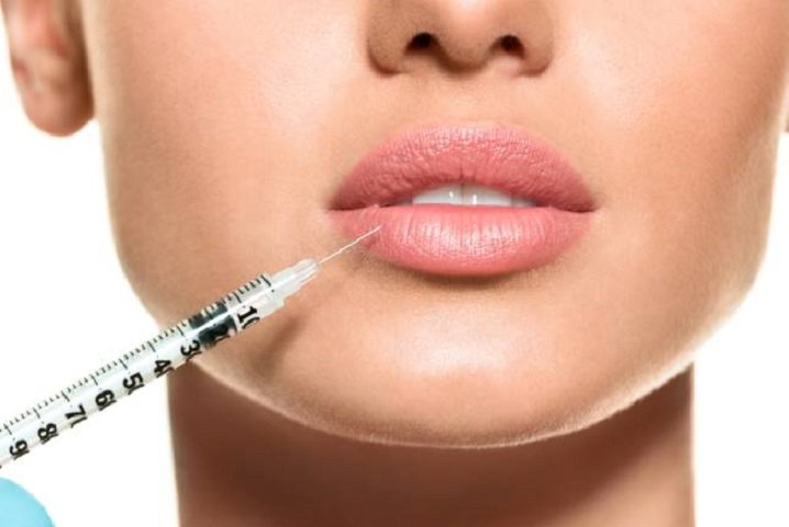 Unlocking the Perfect Pout: All You Need to Know About Lip Fillers